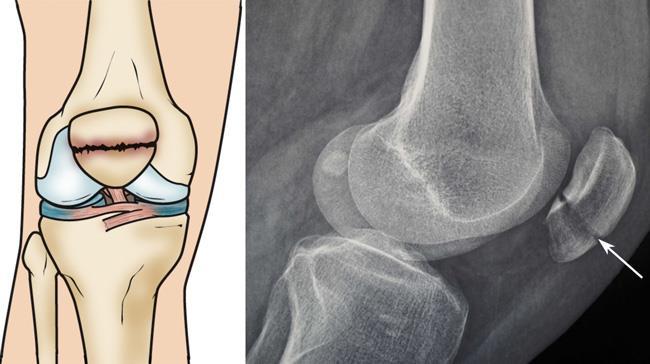 patellar fracture.jpg