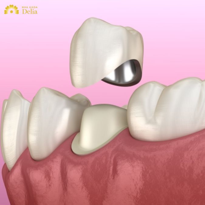 Răng sứ kim loại với độ bền không cao