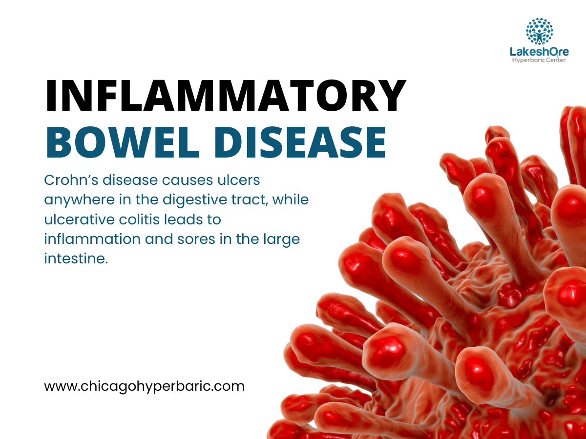 IBD Management: Understanding the Therapeutic Effects of HBOT in IBD