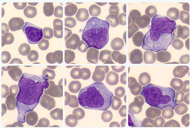 mononucleose infecciosa