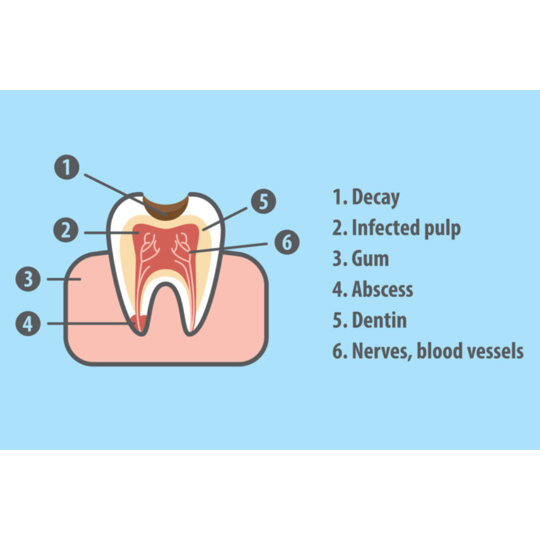 Exposed Nerve Tooth Pain Home Remedy