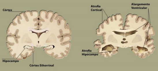 beta amiloide