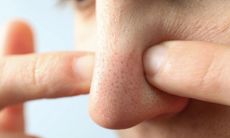 Mụn đầu đen có nên nặn không?