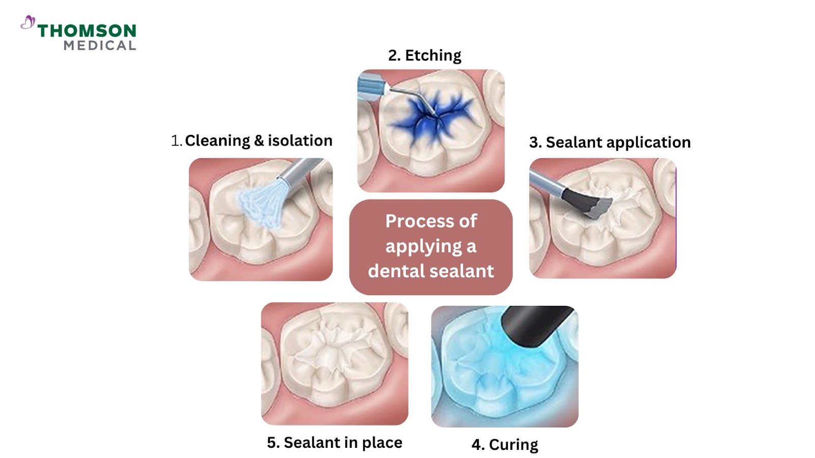 Application of applying dental sealant