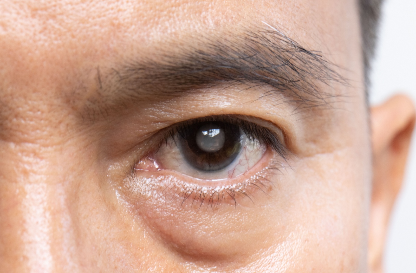 A close-up image of a man's cloudy lens from a cataract.