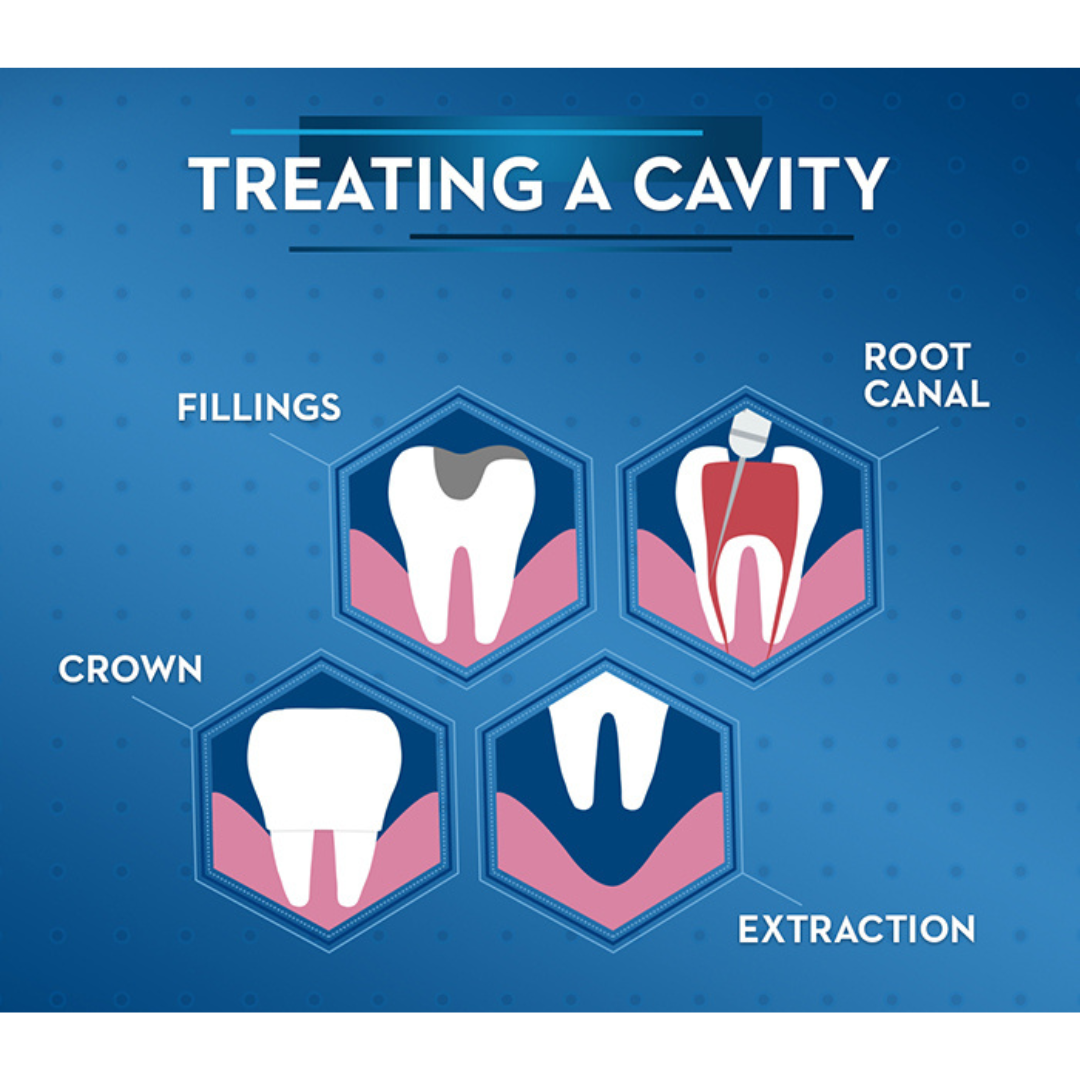 How to Detect and Treat Cavity Under Filling?