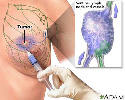 Alt text: Medical illustration showing a needle injecting dye near a breast tumor on light skin, highlighting lymphatic drainage to the sentinel lymph node for biopsy in breast cancer evaluation.