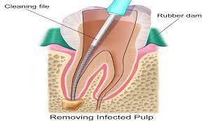 A diagram of a tooth with a tool
