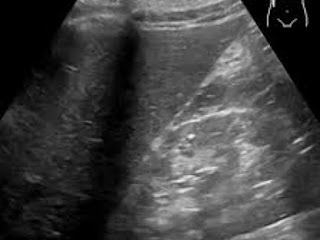 Fatty -Liver - Disease:-  Symptoms, - Treatment, - and - Precautions