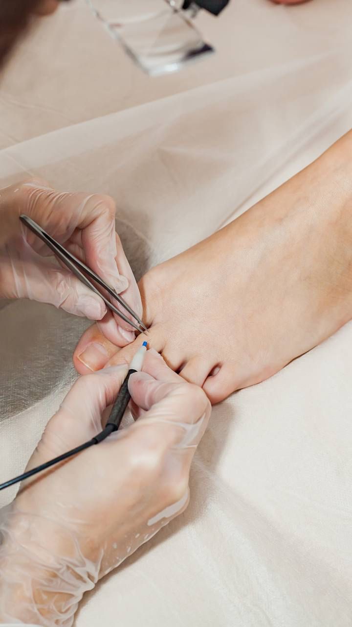 A picture of an electrologists doing electrolysis on someone's toe