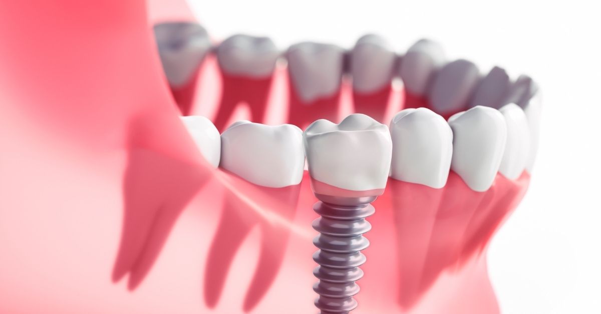 What Are Dental Implants.jpg