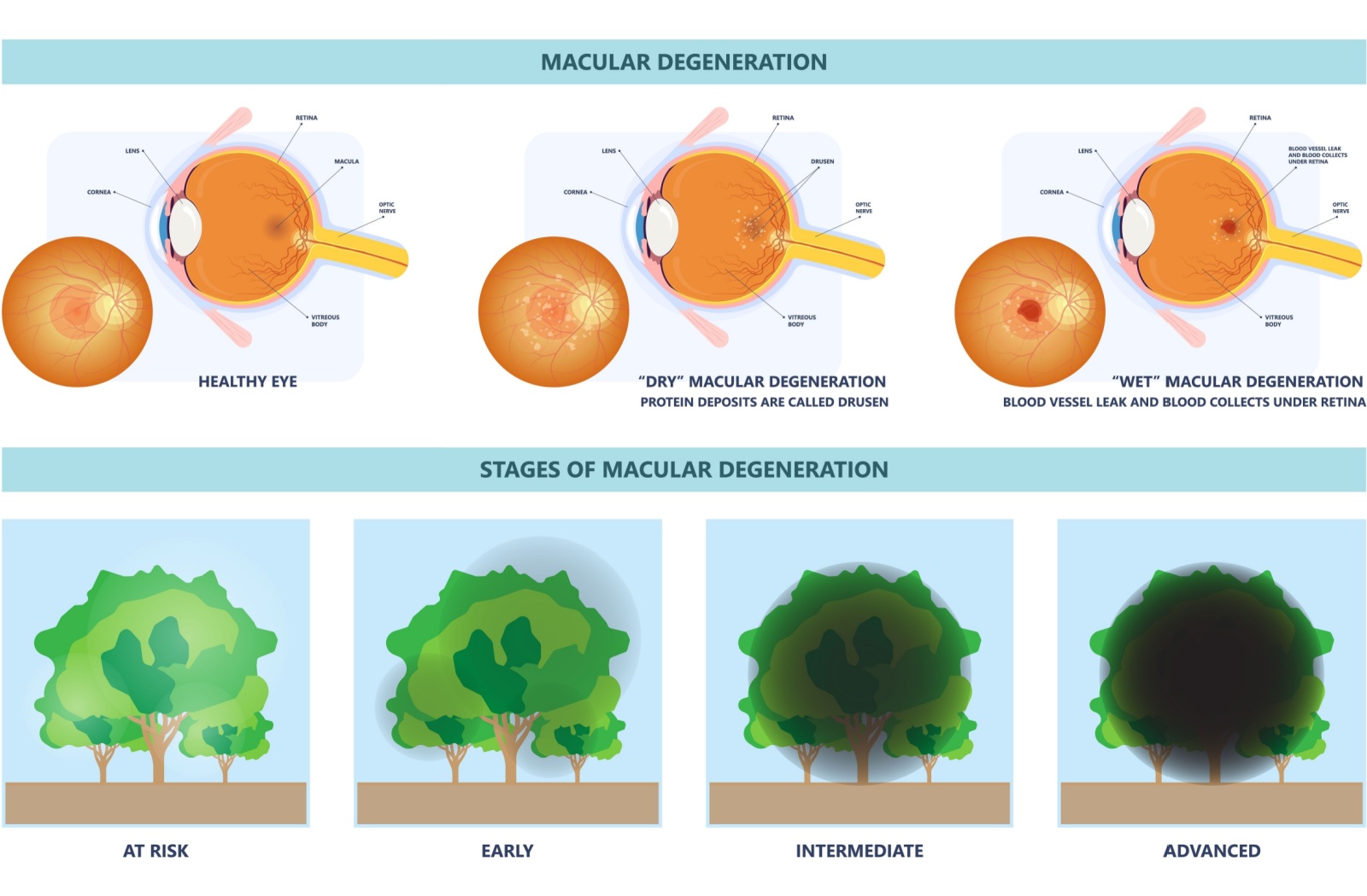 An illustration of macular degeneration in the eye caused by protein deposits and blood vessel leaks. Also, stages of macular degeneration with what vision would look like.