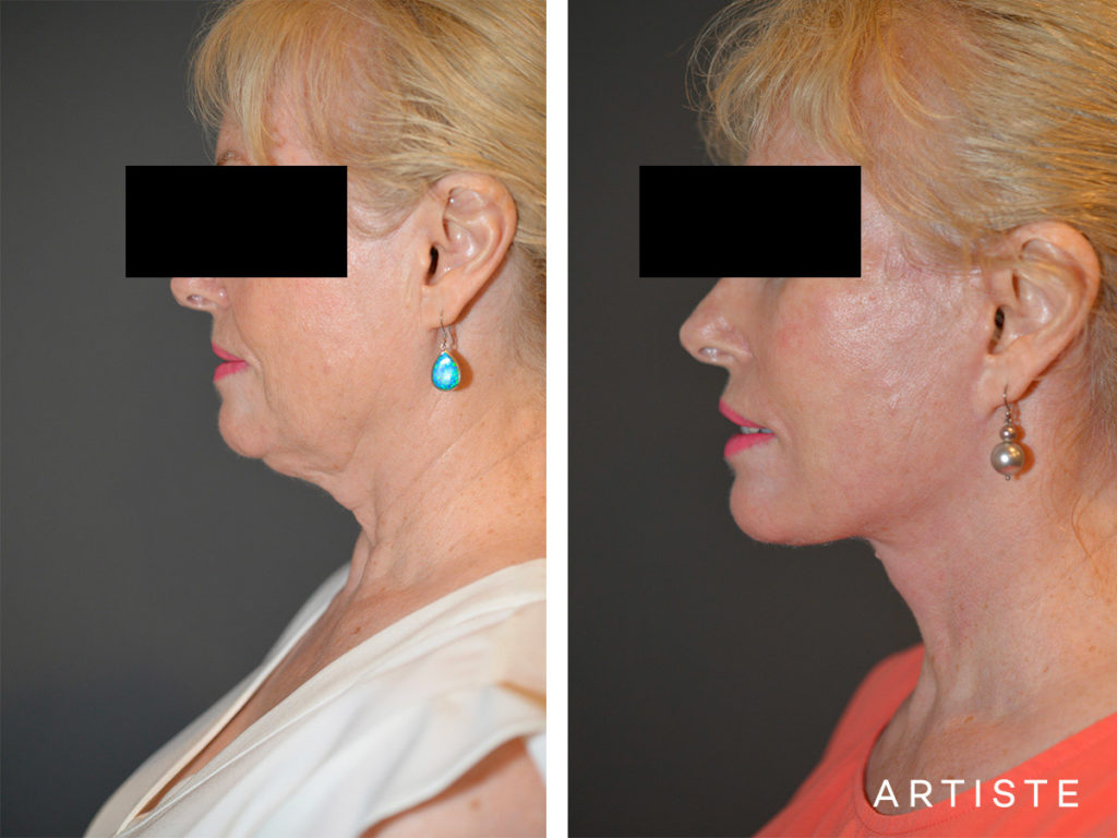64 Years Old High SMAS Face and Neck Lift