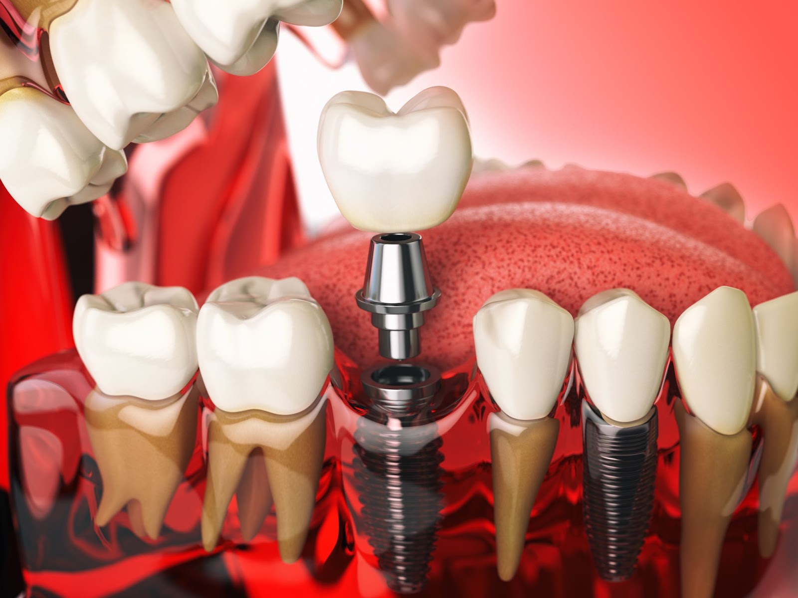 A detailed 3D illustration of a dental implant being placed in a model of human teeth and gums. The image shows the titanium implant screw anchored into the jawbone, a metal abutment, and a ceramic crown being positioned on top. Surrounding natural teeth and gums are shown for context, highlighting the implant's integration into the oral structure. The red background accentuates the anatomical details. This is one of the modern techniques.