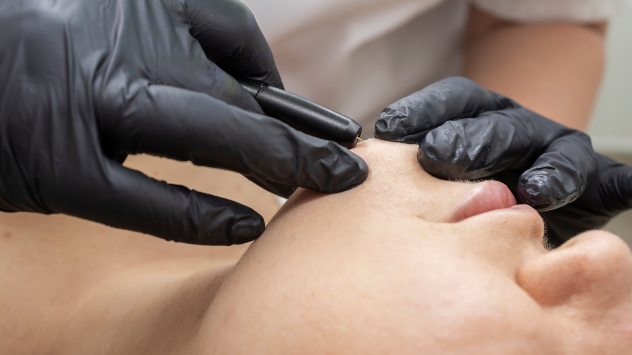 This is an image that shows electrolysis service being carried out on the chin of a client.