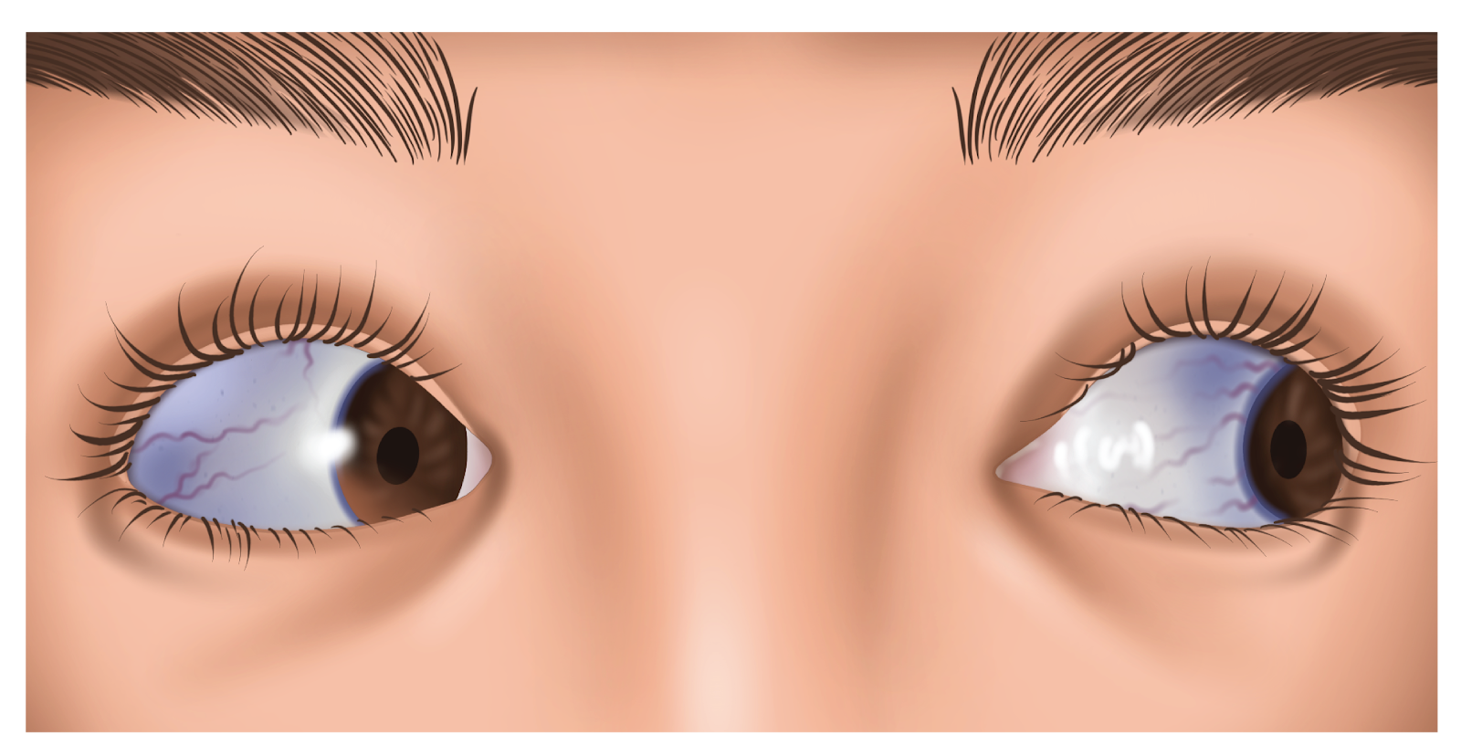 Osteogenesis imperfecta