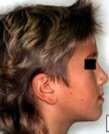 RÃ©sultat de recherche d'images pour "proalvÃ©olie infÃ©rieure traitement"