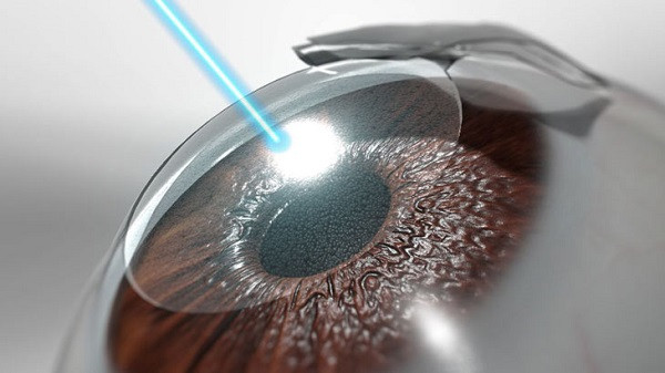 Ưu điểm nổi bật khi mổ Femto Lasik