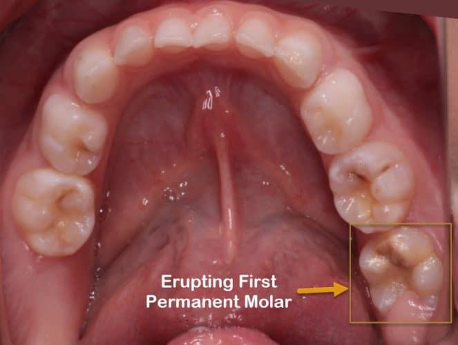 Cheese Molars in Kids, MIH Information