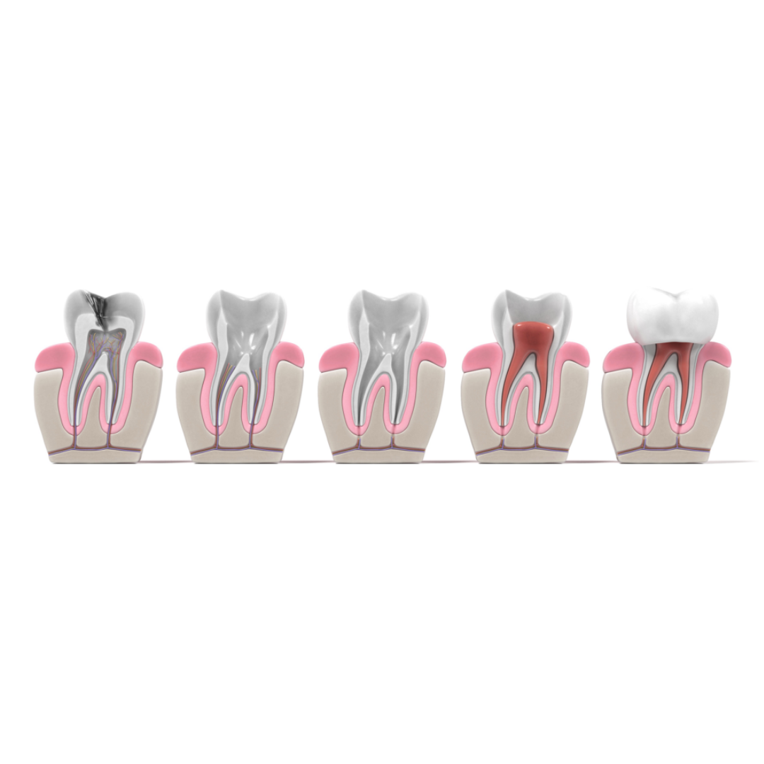 how long does a root canal take