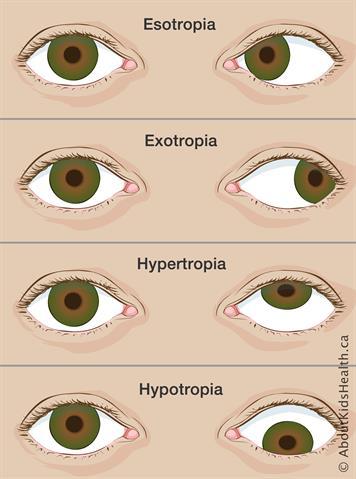 Pairs of eyes with esotropia, exotropia, hypertropia and hypotropia