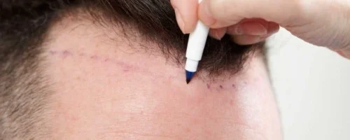 Experience Excellence in Hair Restoration