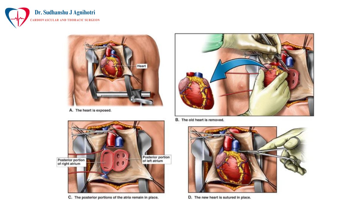 Heart-Transplant by Dr Sudhanshu J Agnihotri Top 10 Cardiologist in Indore
