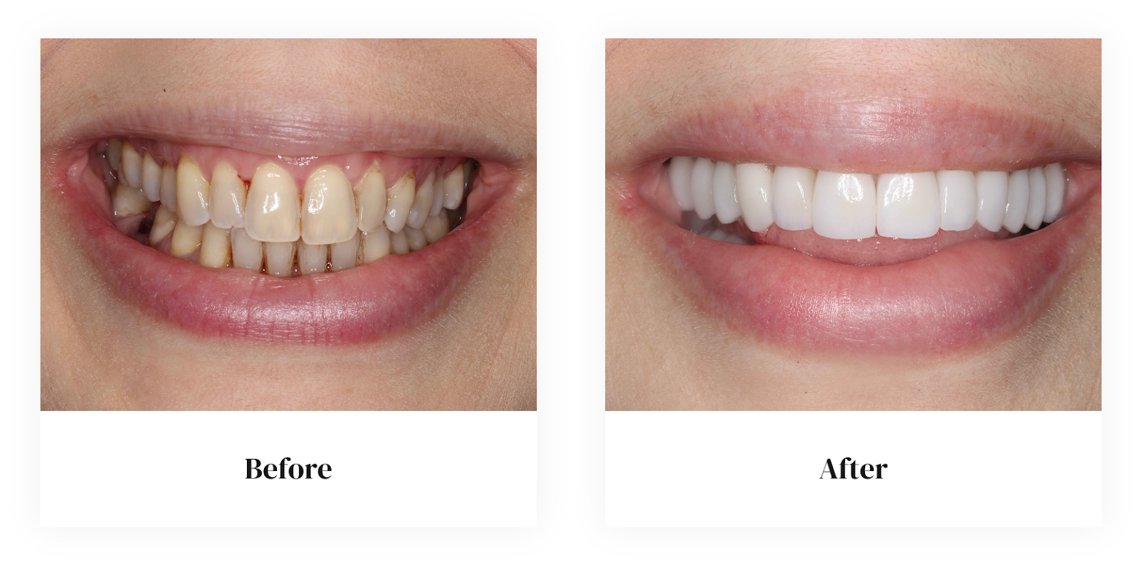 Veneers before and after