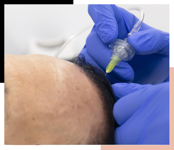 Carboxiterapia Capilar – Elegance