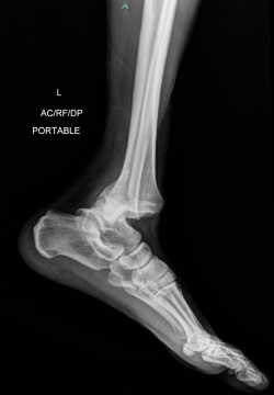 X-ray of a foot

Description automatically generated