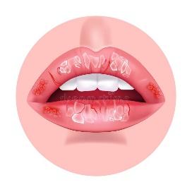 Chapped Lips Stock Illustrations – 52 Chapped Lips Stock Illustrations, Vectors & Clipart - Dreamstime