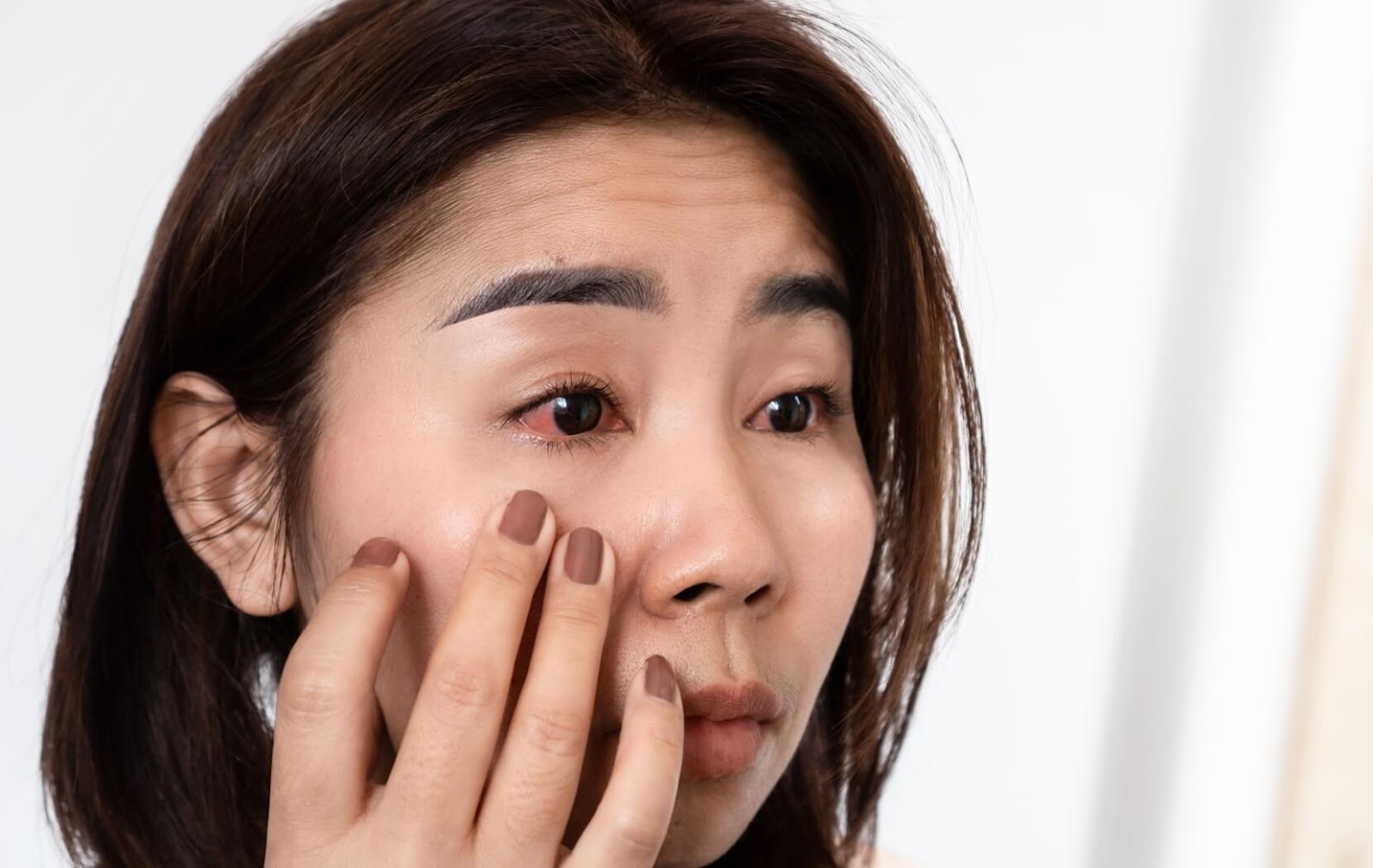 A person gently touches their upper cheek while looking at their injured eye that is red and swollen.