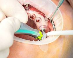 Image of Guided Implant Surgery Procedure