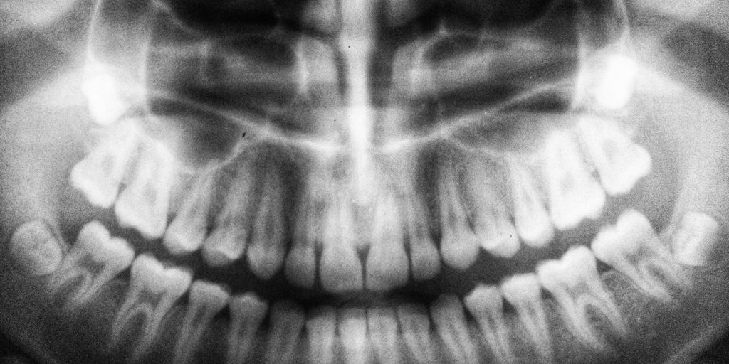 teeth X-ray