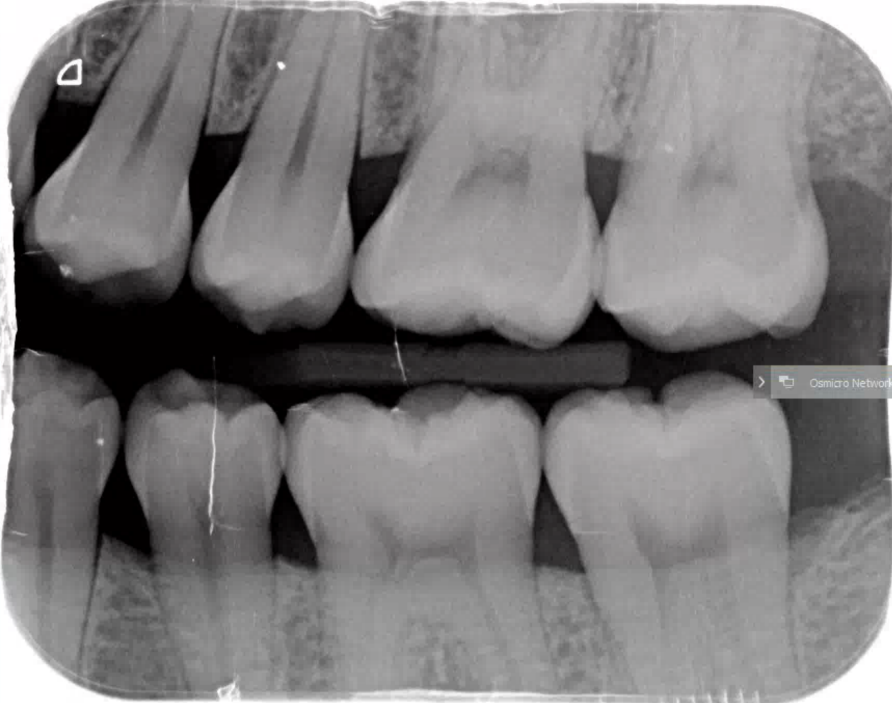 Bite wing x-ray