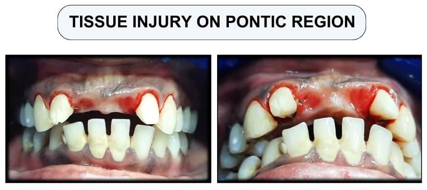 tissue injury