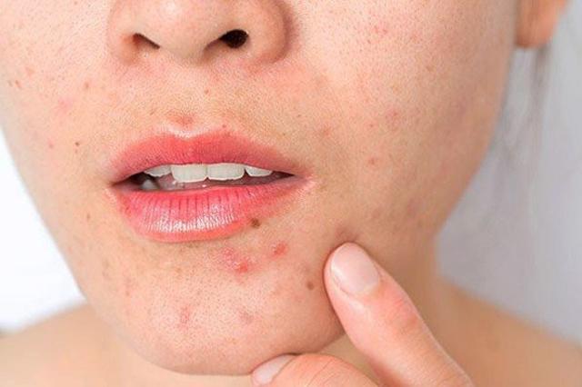 Dễ nổi mụn là một trong các dấu hiệu nhận biết da của bạn là da nhạy cảm