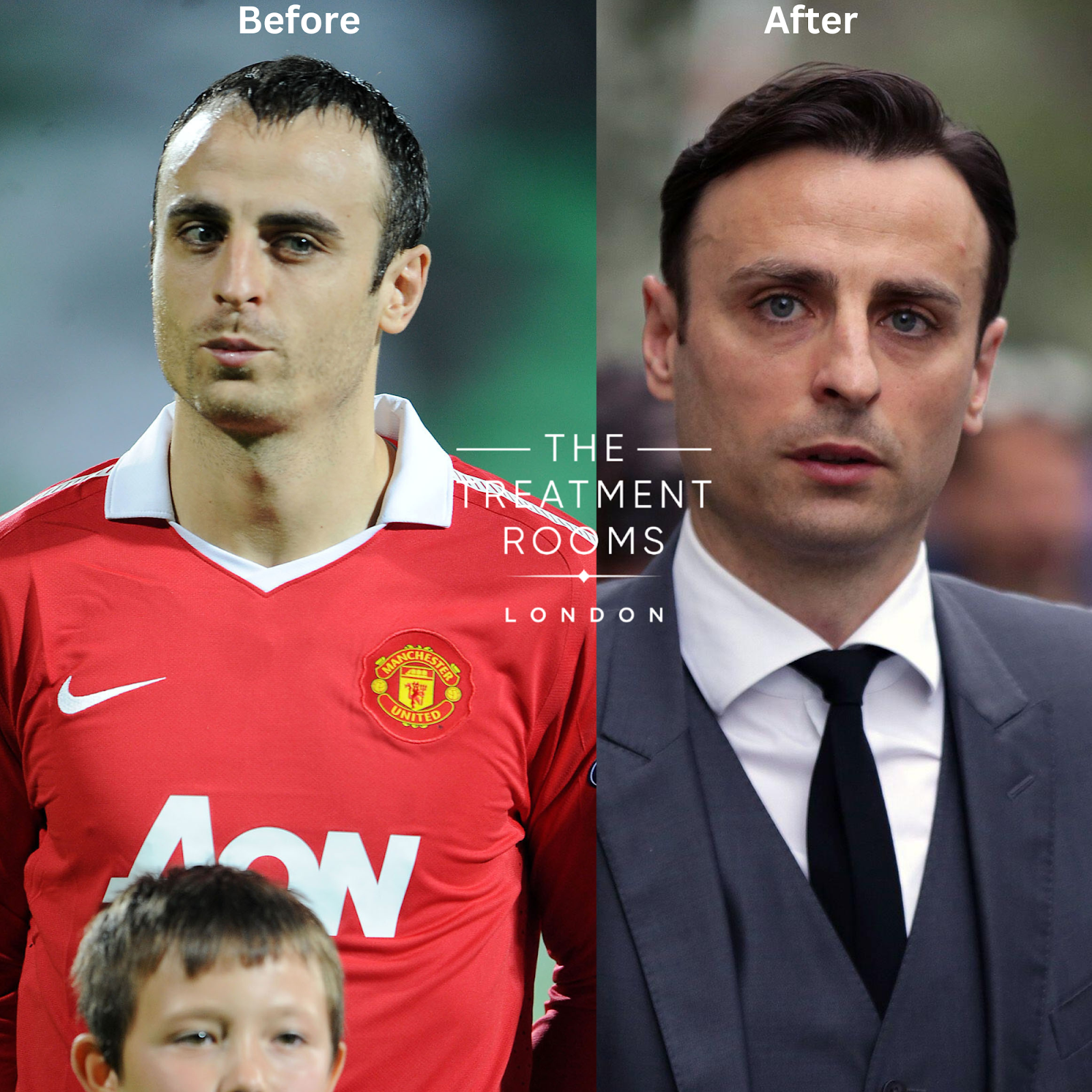 Dimitar berbatov's hair transplant. The image shows an M-Shaped receding hairline turned to a full hairline after the procedure.