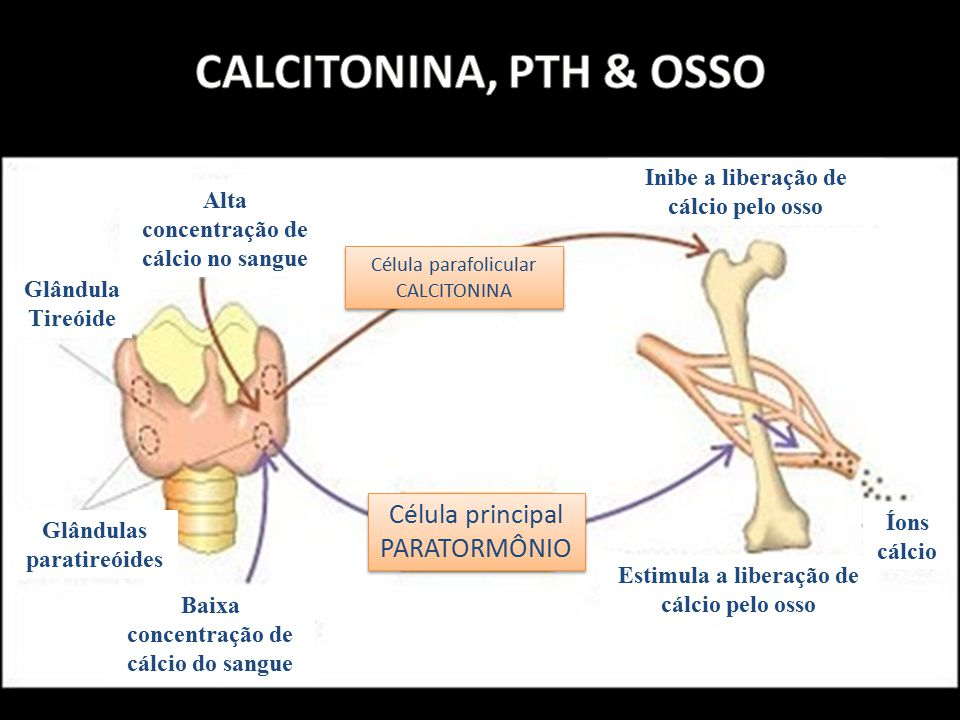 hipocalcemia