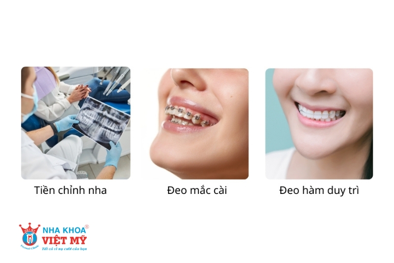 các giai đoạn niềng răng hô