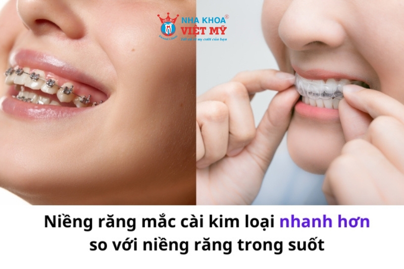 phương pháp niềng răng ảnh hưởng đến thời gian niềng răng