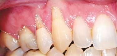 Recouvrement de récessions gingivales de classe I de Miller avec lésions  cervicales d'usures – L'Information Dentaire