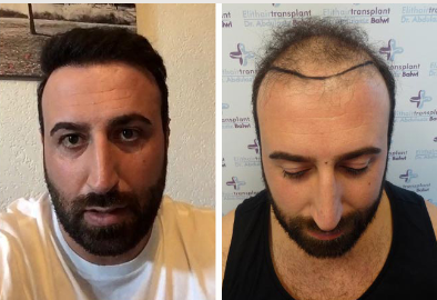 زراعة الشعر قبل وبعد للسيد ارتين - مركز اليت هير لزراعة الشعر