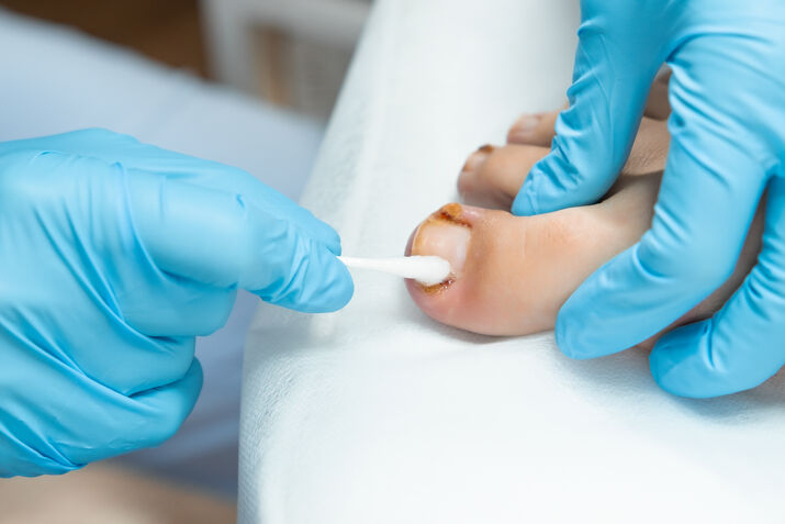 Pedicure with Athlete’s Foot - foot cleaning
