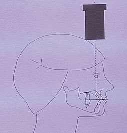 Résultat de recherche d'images pour "cliché occlusale technique"