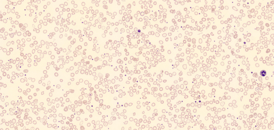 doença renal crônica