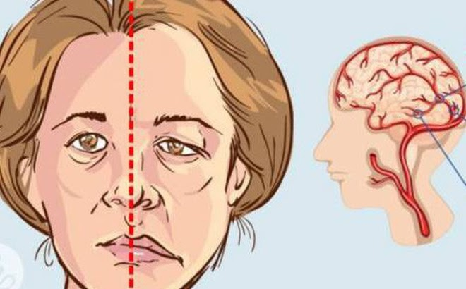  Miệng méo là dấu hiệu điển hình của cục máu đông trong não