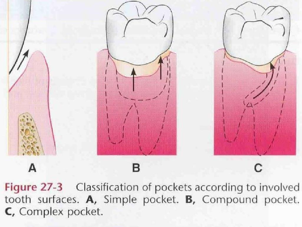periodontal-pocket-pathogenesis-14-1024.jpg