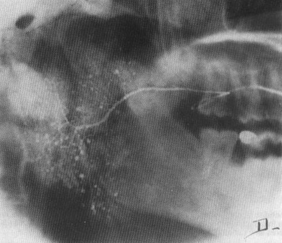 Patologías infecciosas e inflamatorias de las glándulas salivales