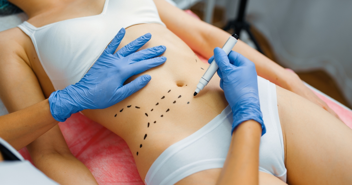 Can Liposuction Cause Fat Embolism